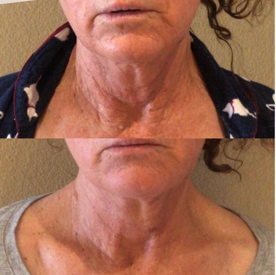 A woman 's neck is shown in a before and after photo