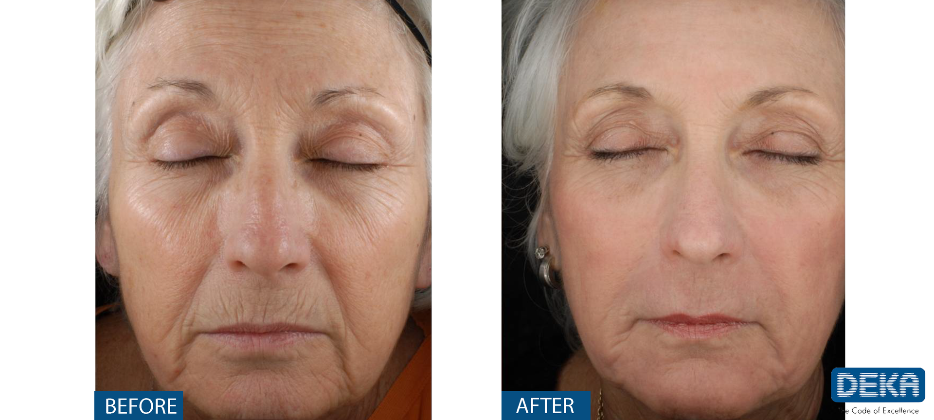 A before and after photo of a woman 's face with her eyes closed.
