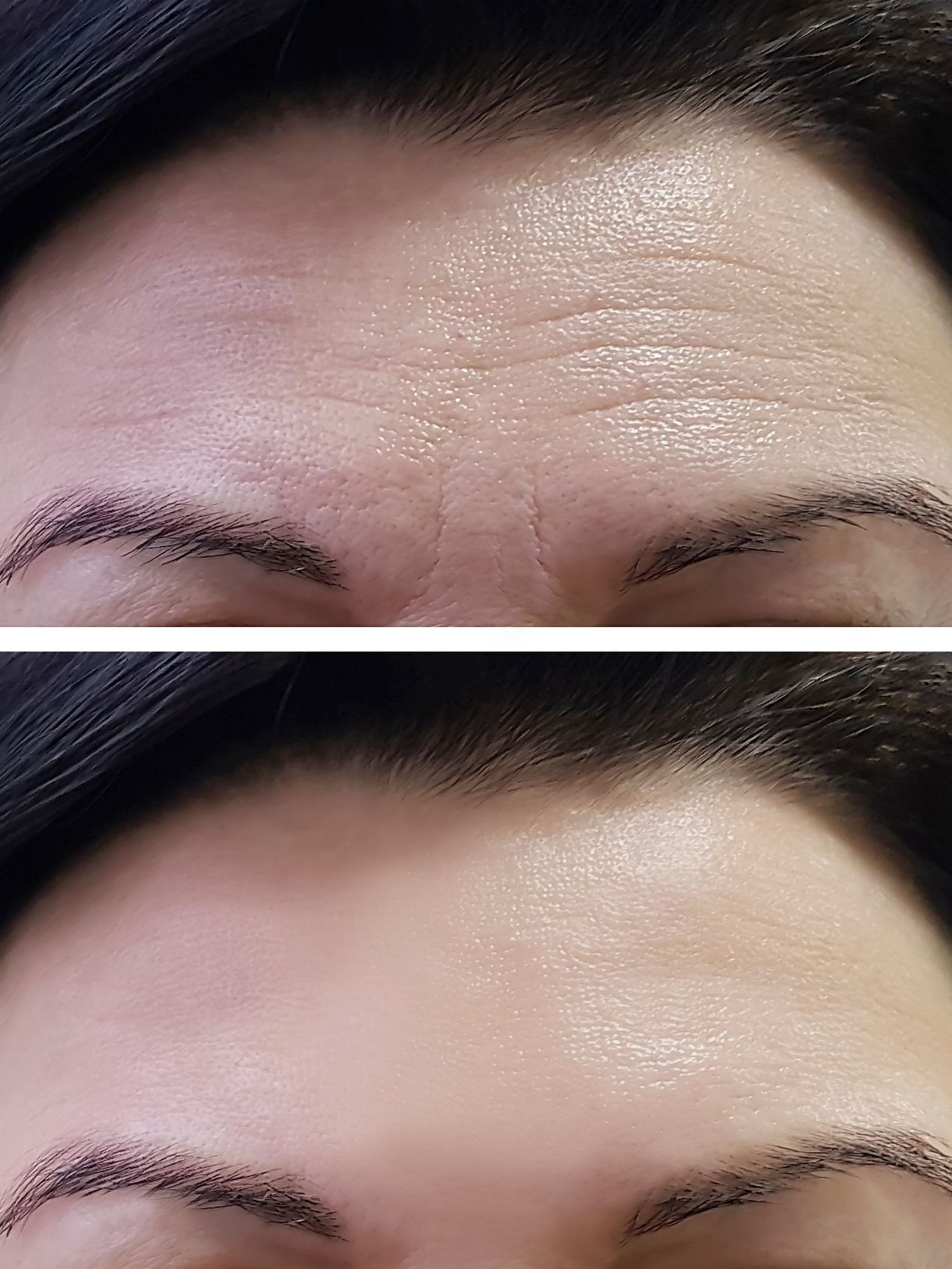 before and after micrchanneling treatment