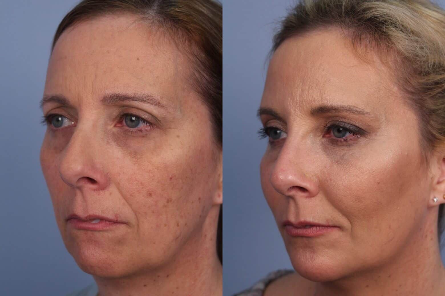 A before and after photo of a woman 's face.