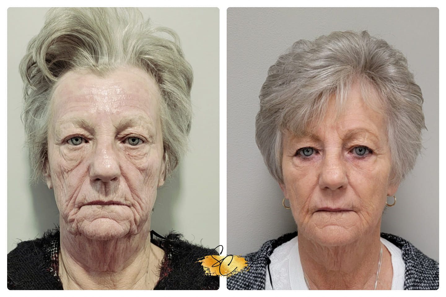 A before and after photo of a woman 's face.