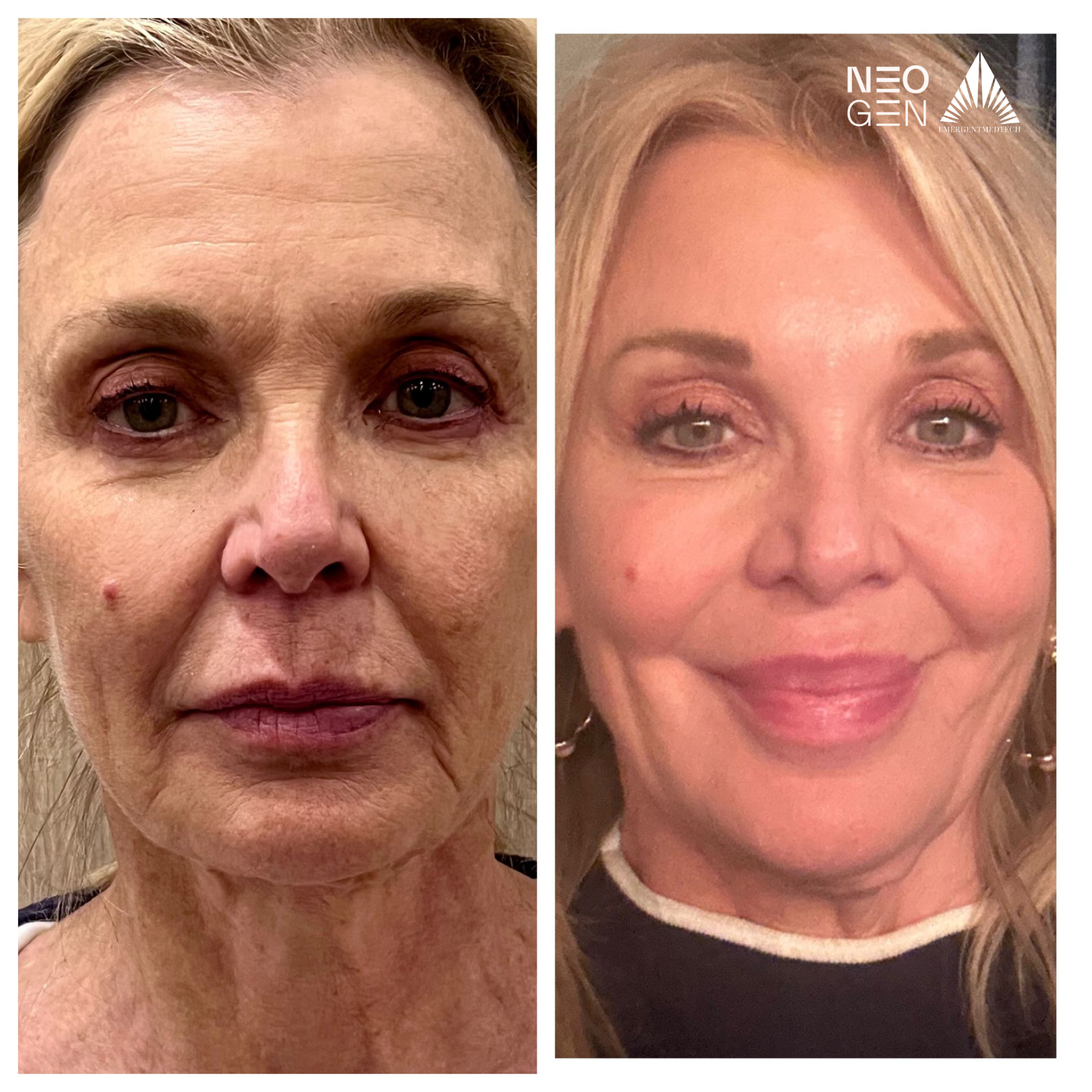 A before and after photo of a woman 's face.