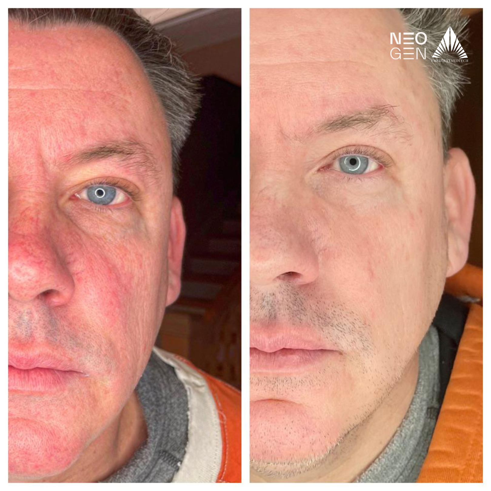 A before and after photo of a man 's face with blue eyes.