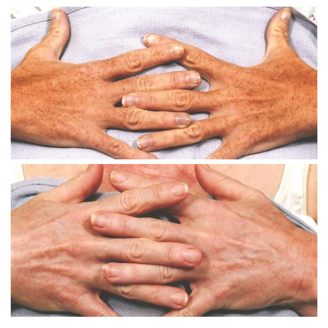 Top: Two hands interlaced, showing signs of aging and sun exposure. Bottom: Two hands interlaced, appears younger.