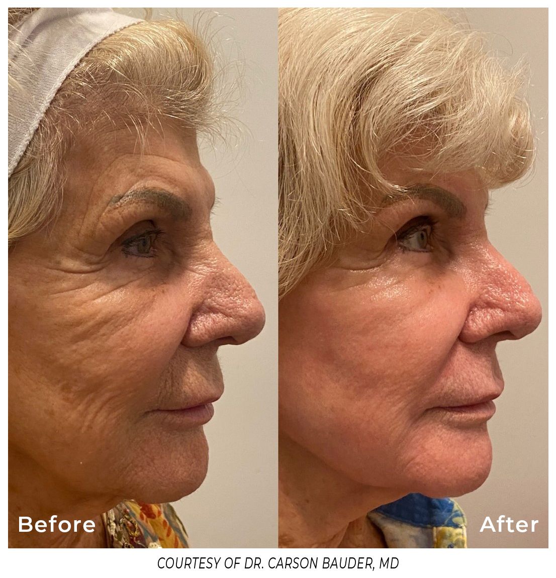 Before and after profile photos of an older woman. Wrinkles reduced, skin appears smoother.