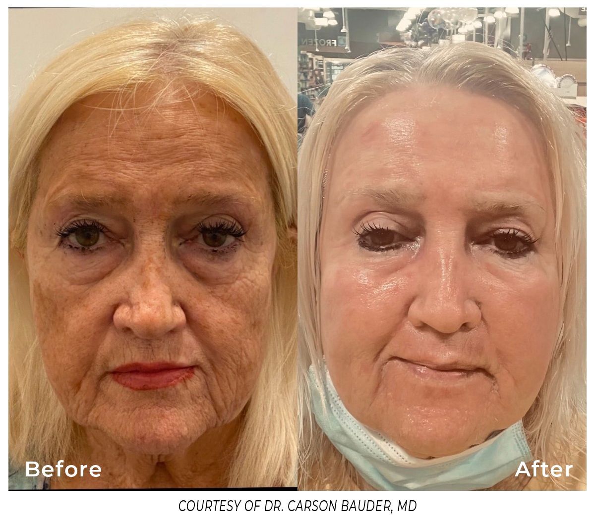 Before-and-after facial photos of a woman with wrinkles. After photo shows smoother skin, with a mask.
