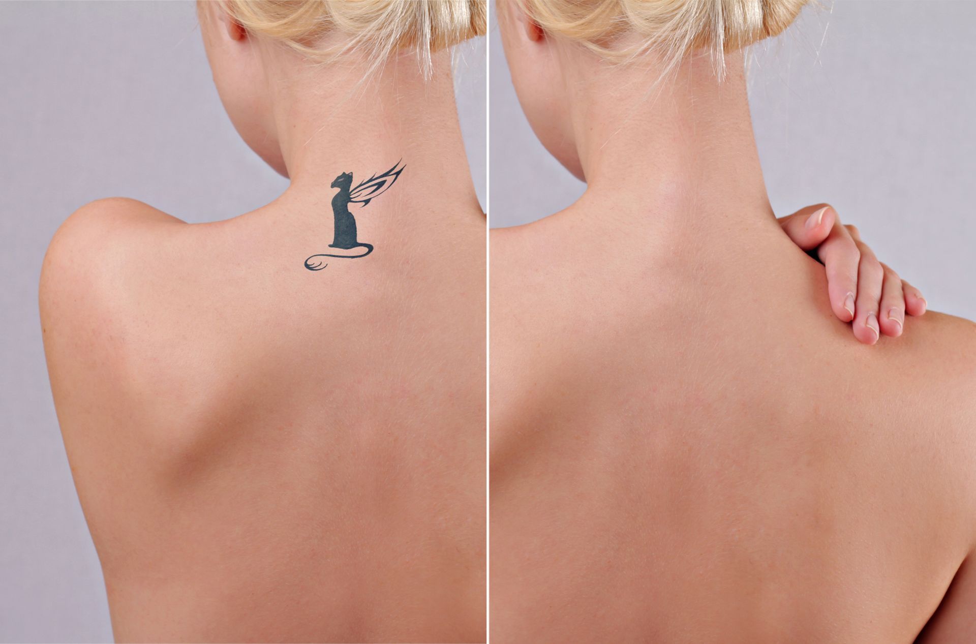 Back of a person's upper back, showing a tattoo before removal on left and clear skin on right, demonstrating tattoo removal.