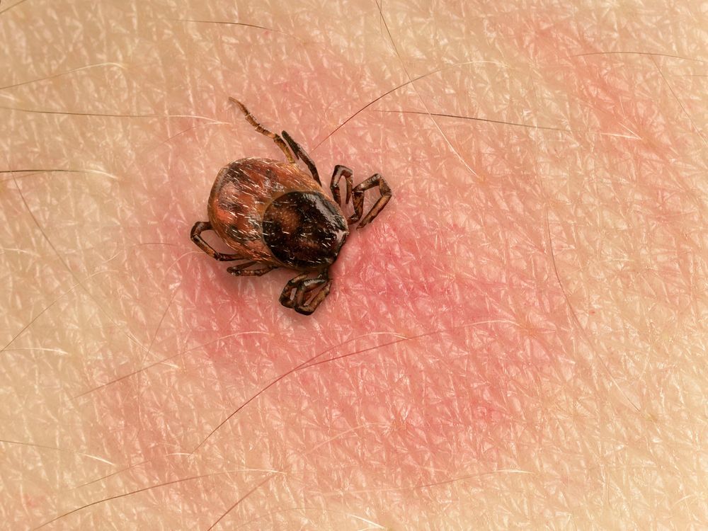 Tick embedded in the skin with a red reaction on the skin around the bit area