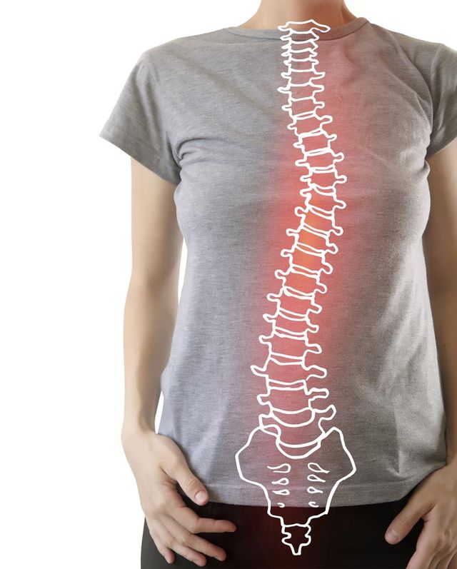 Woman with scoliosis of the spine. Curved woman's back. Stock Photo