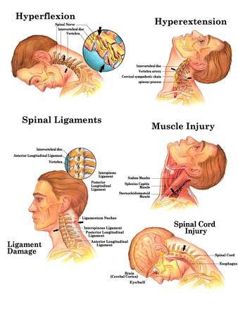 diagram of whiplash