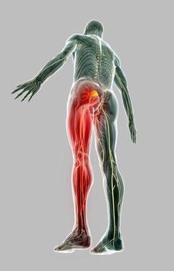 Sciatic Nerve Pain for Long Beach, CA, Coast Neurosurgical Associates