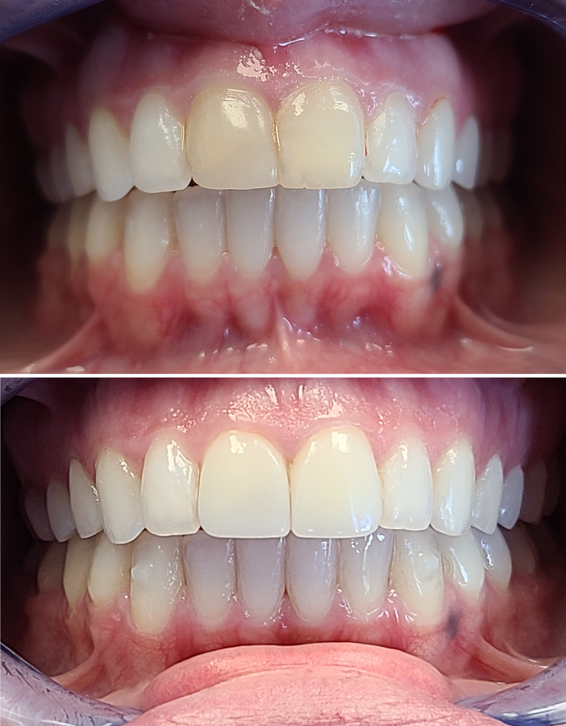 Dental Procedure Before & After