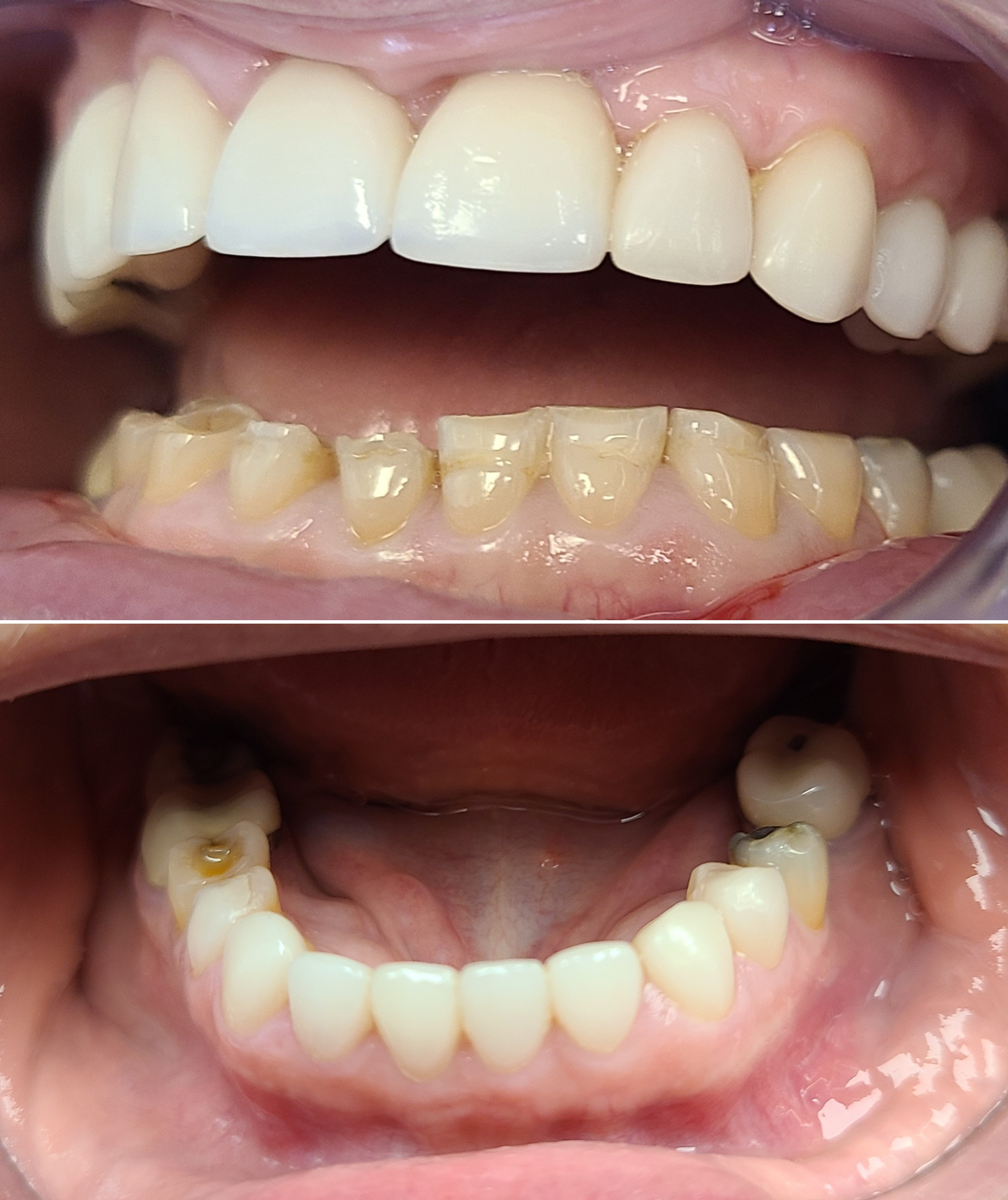 Dental Procedure Before & After