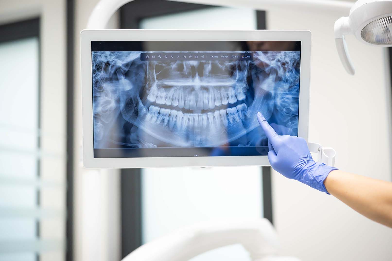 Digital dental X-ray technology at a Babylon NY dental office