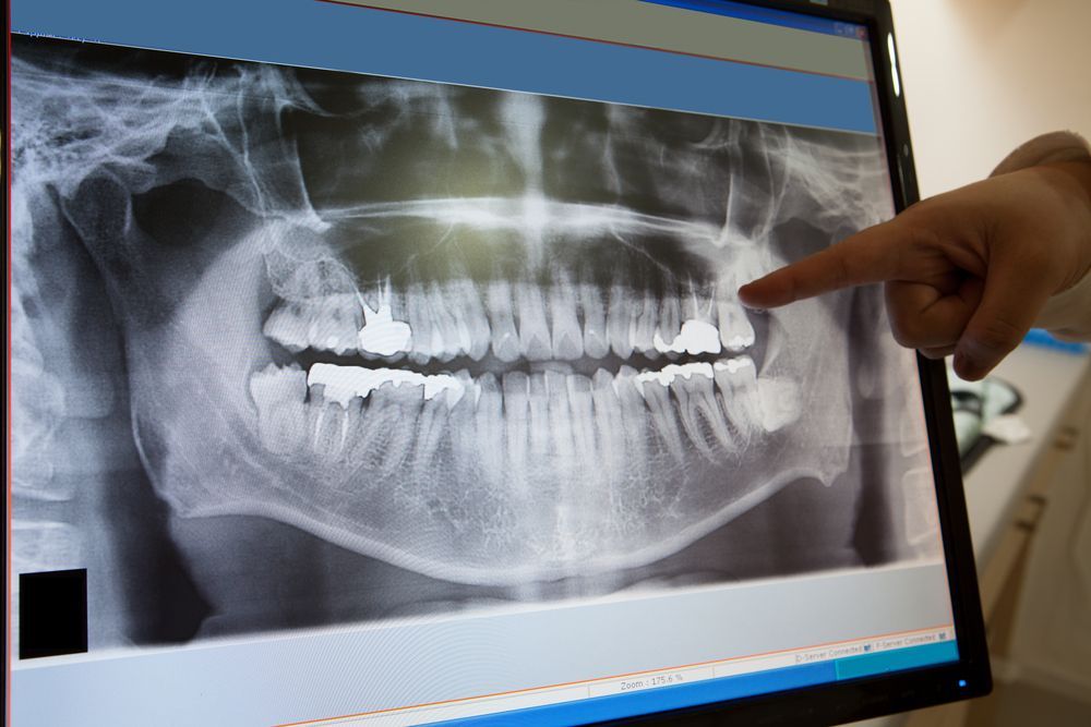 Tooth Extractions Long Island New York 