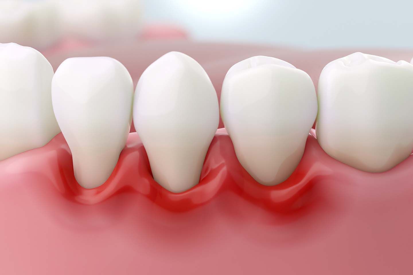 Periodontal Dentistry in Suffolk County NY. Dr. Colleen L. Catera DMDm