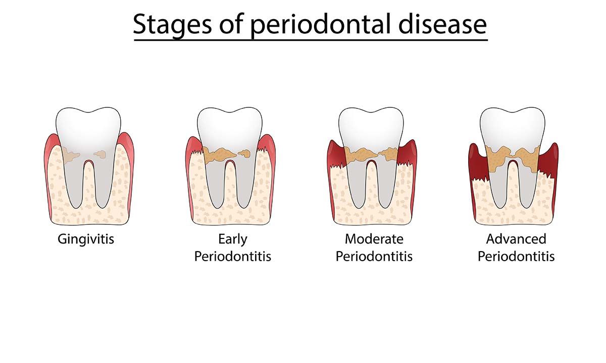 stages of periodontal disease 
