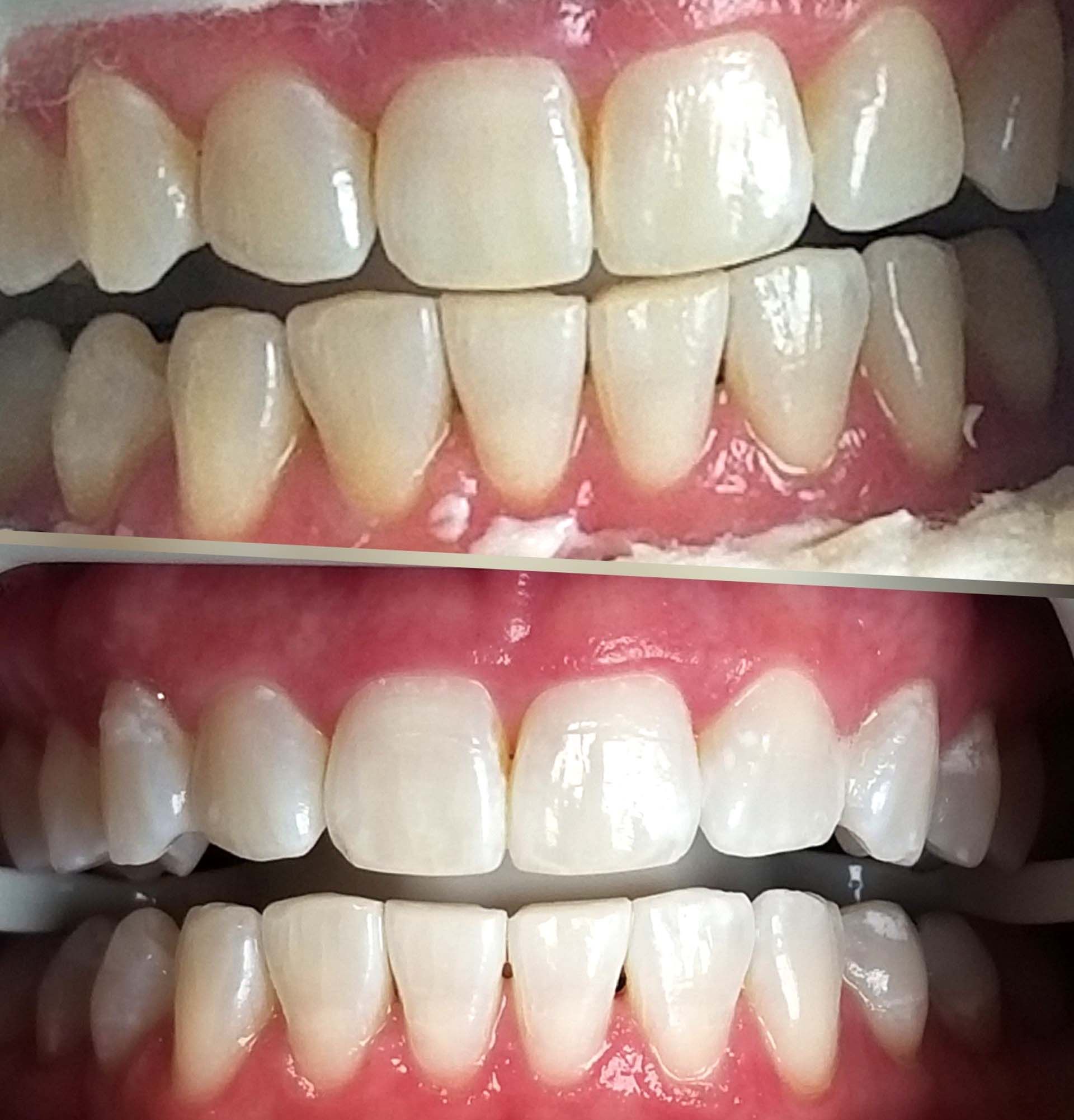 Dental Procedure Before & After