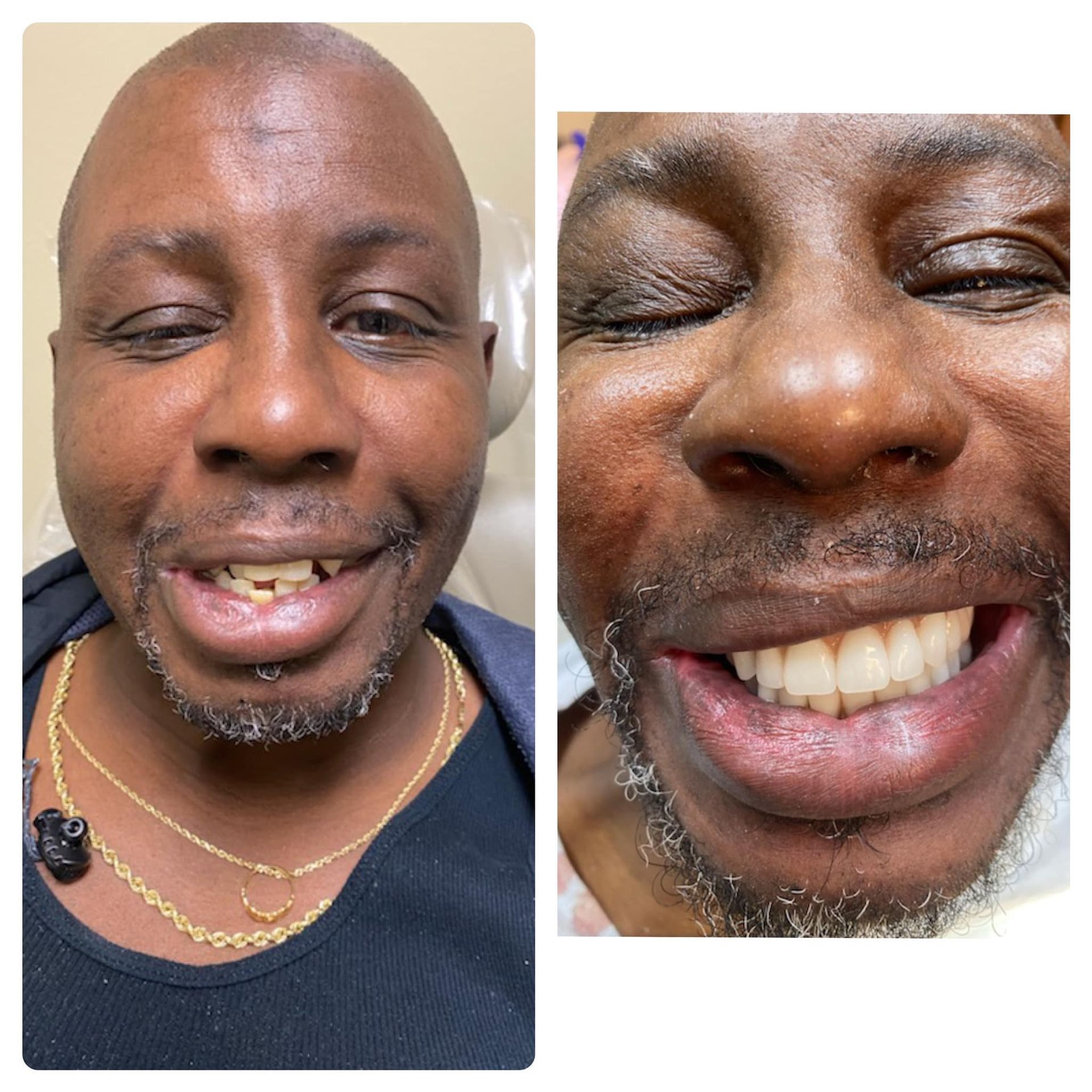 dental implants before and after innate dental solutions