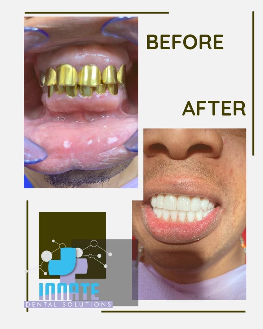 dental implant before and after plano tx
