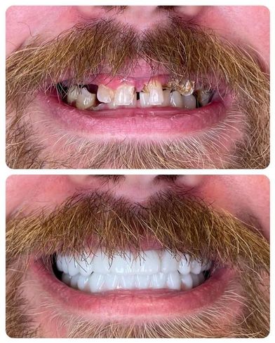 dental implants before and after innate dental solutions