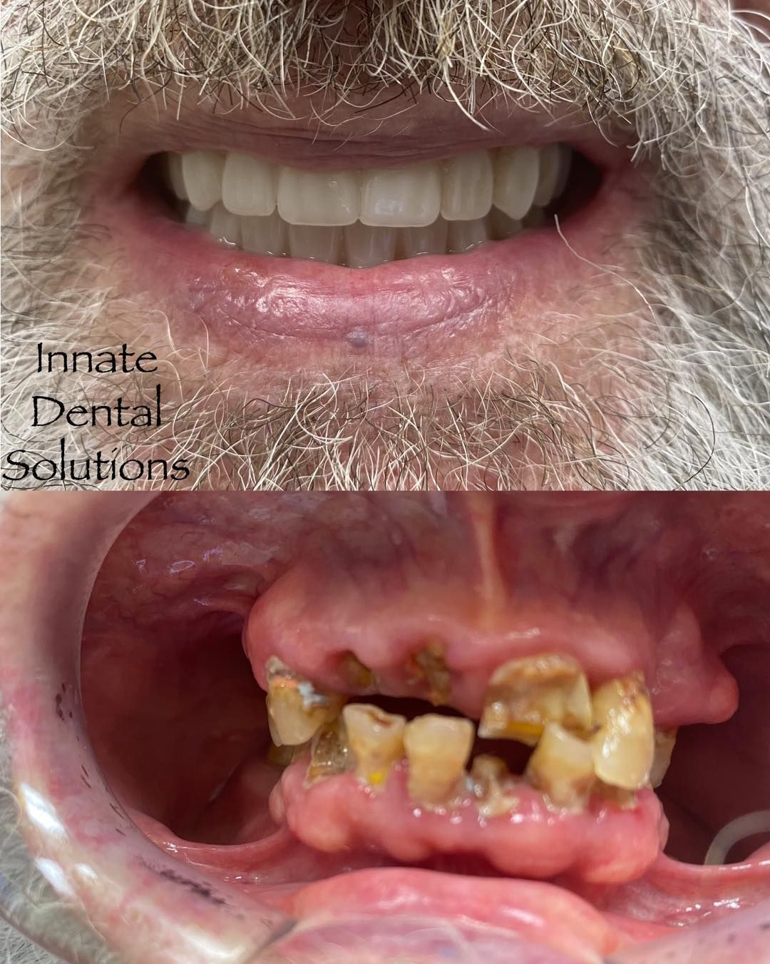 dental implant before and after plano tx