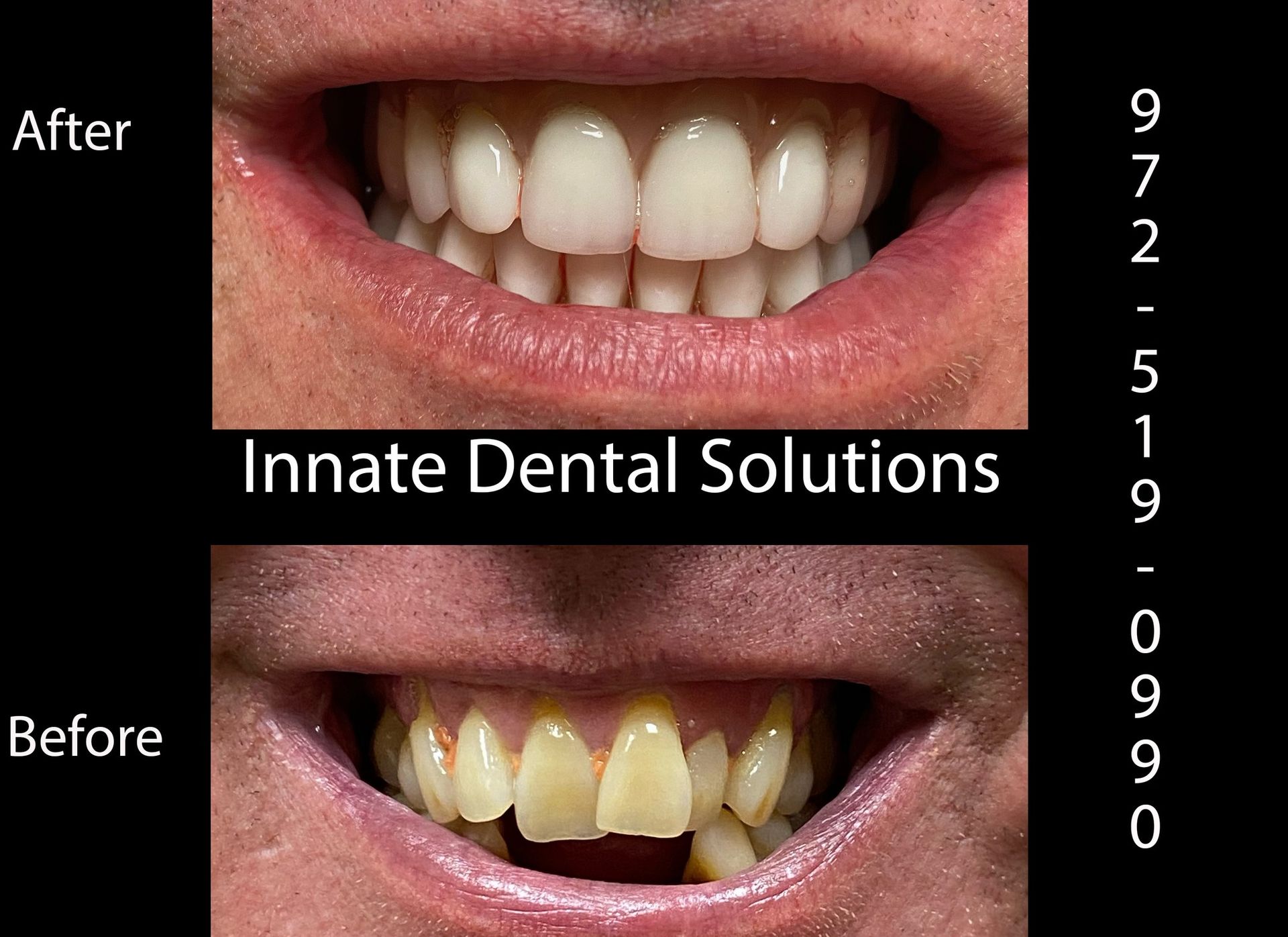 dental implant before and after plano tx