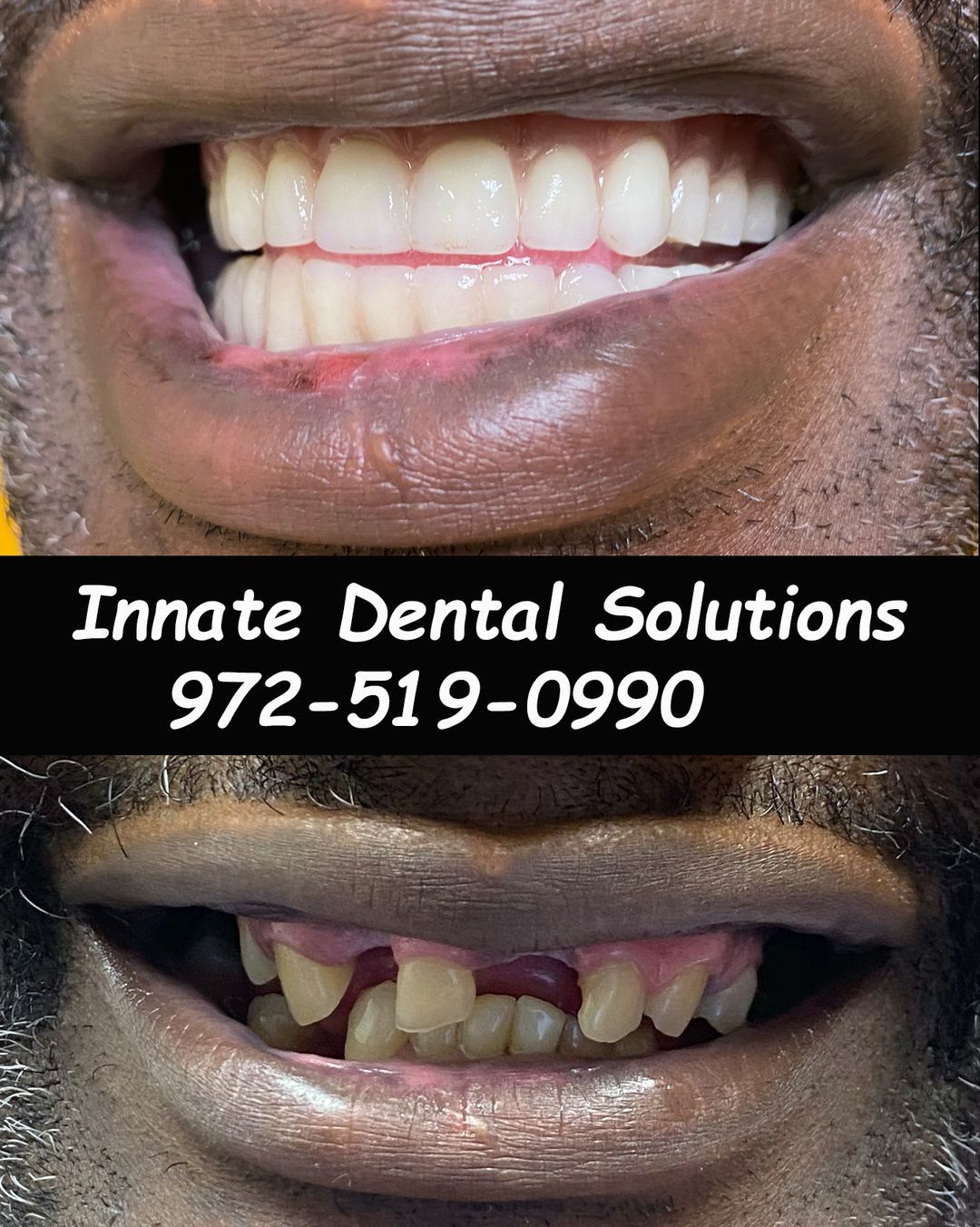 dental implant before and after plano tx