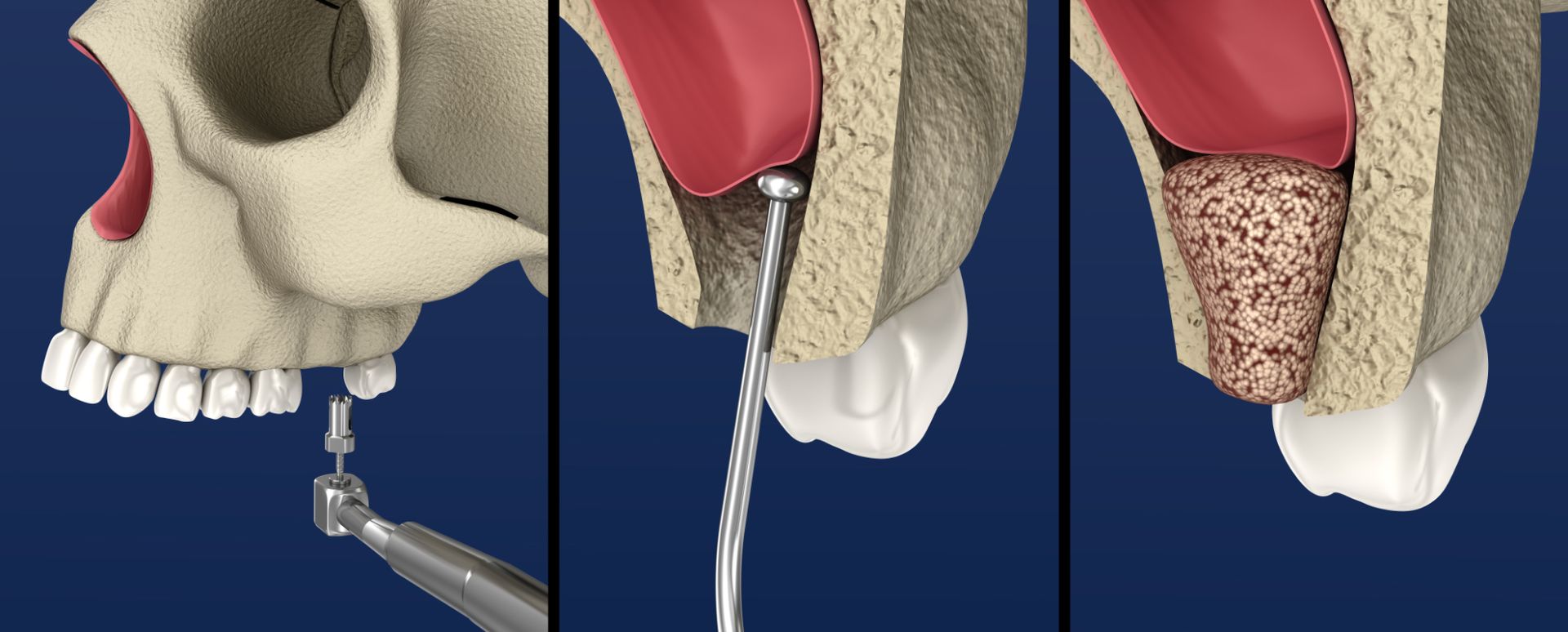 A skull is being drilled with a drill and a tooth is being removed.