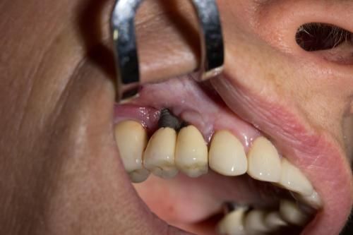 A close up of a person's mouth with a dental implant failure