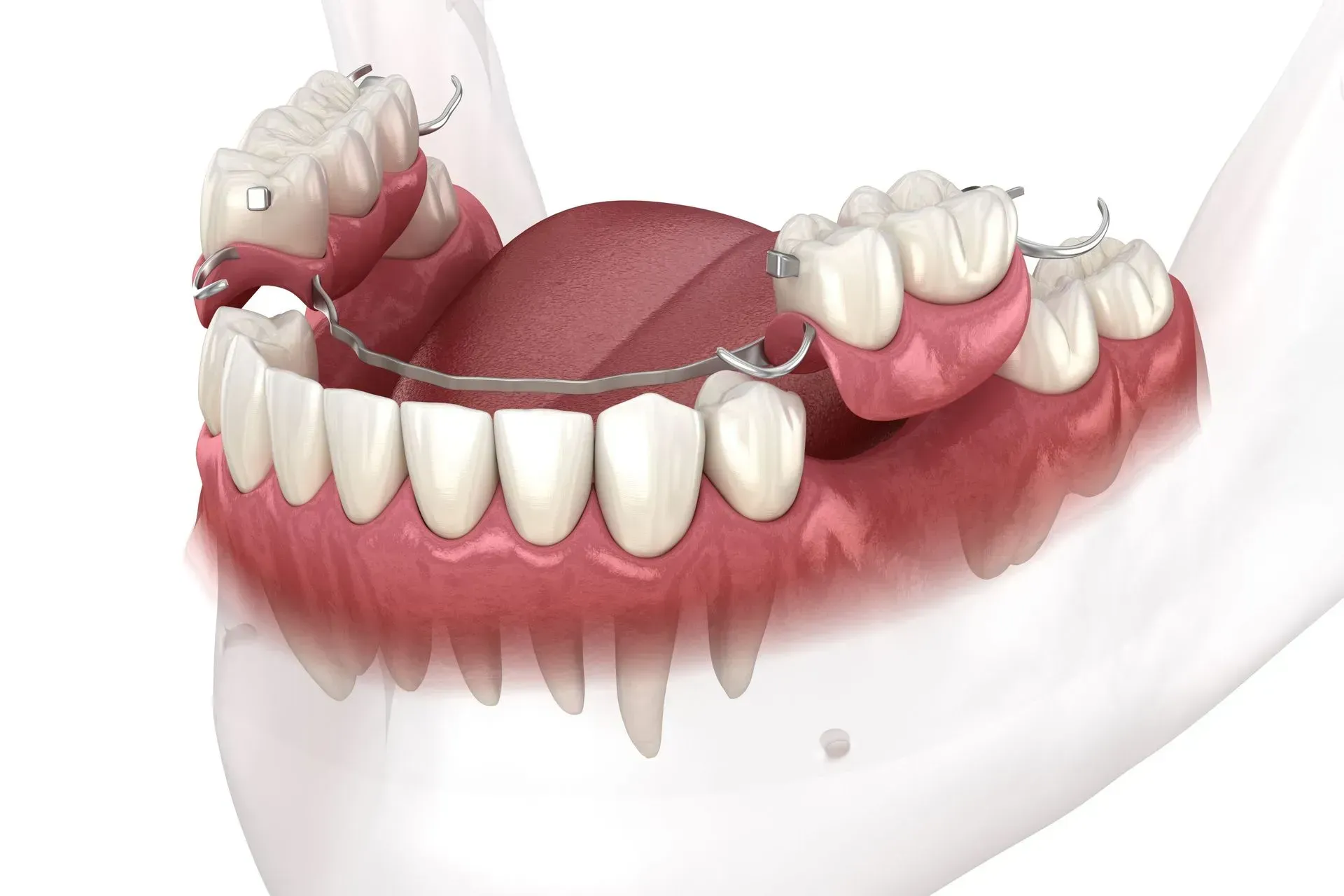 Dental flippers plano tx