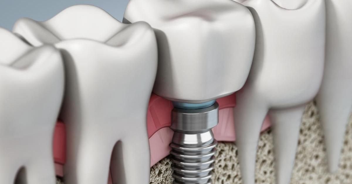 Single-Tooth Dental Implants: Cost, Procedure & Benefits