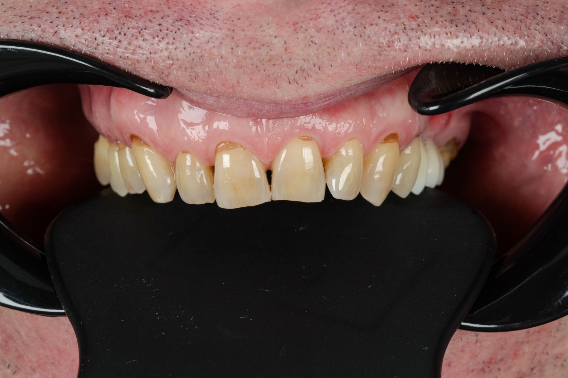 A close up of a man 's teeth with gum recession.