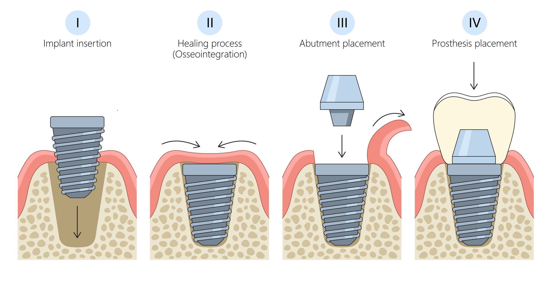 A diagram showing the steps of dental implantation
