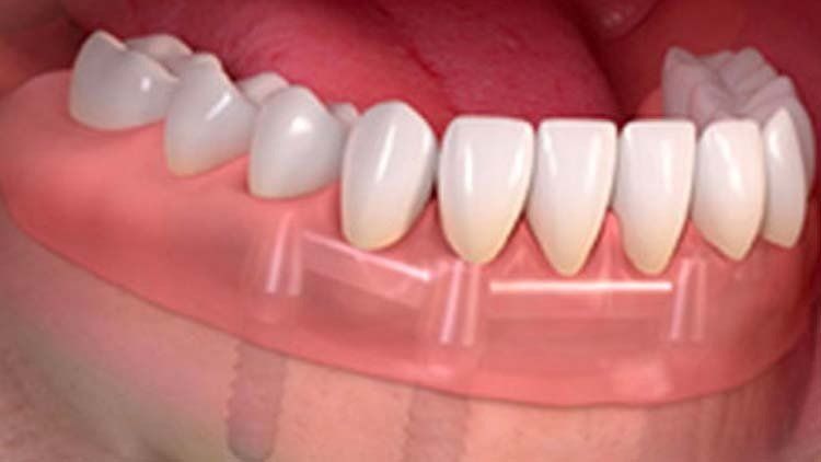 stabili-teeth dental implant plano tx