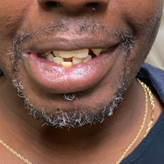 dental implant before and after plano tx