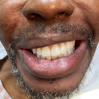 dental implant before and after plano tx