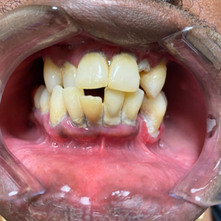 dental implant before and after plano tx