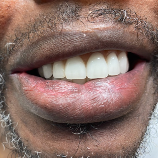 dental implant before and after plano tx
