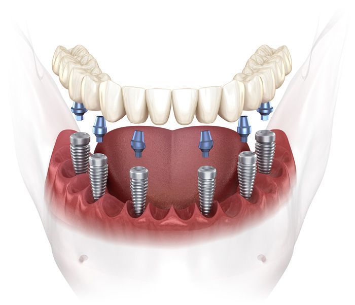 A computer generated image of a full mouth with dental implants.