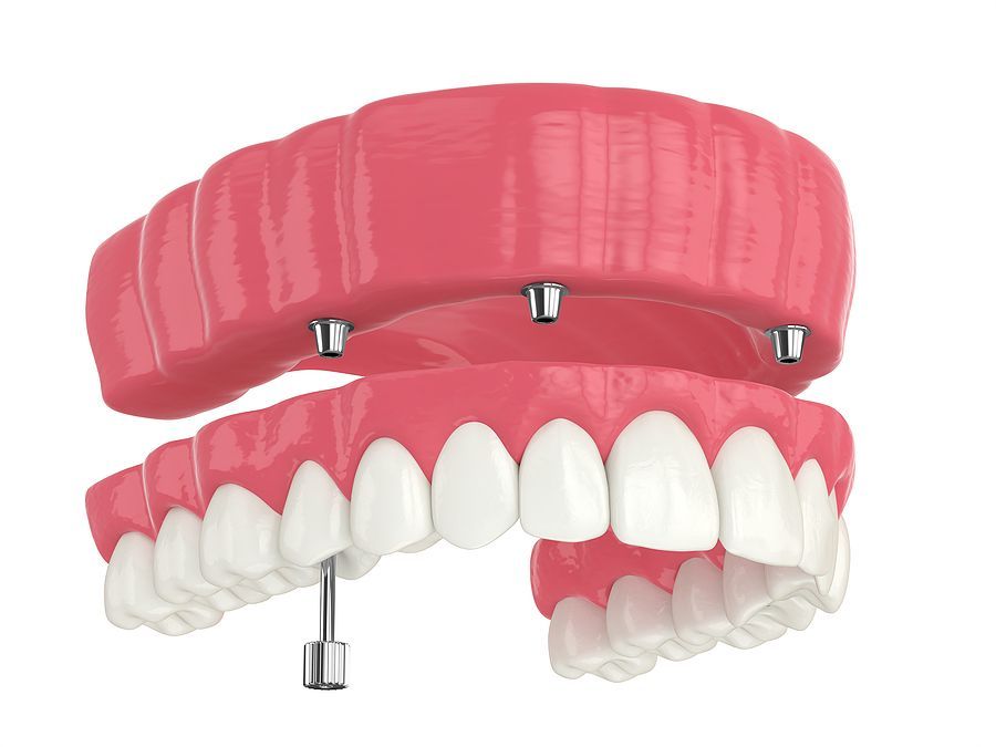 snap on dental implants plano tx