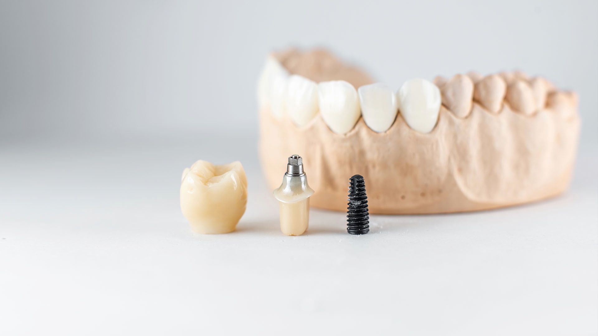 Dental implant components: crown, abutment, and implant next to a model of teeth.
