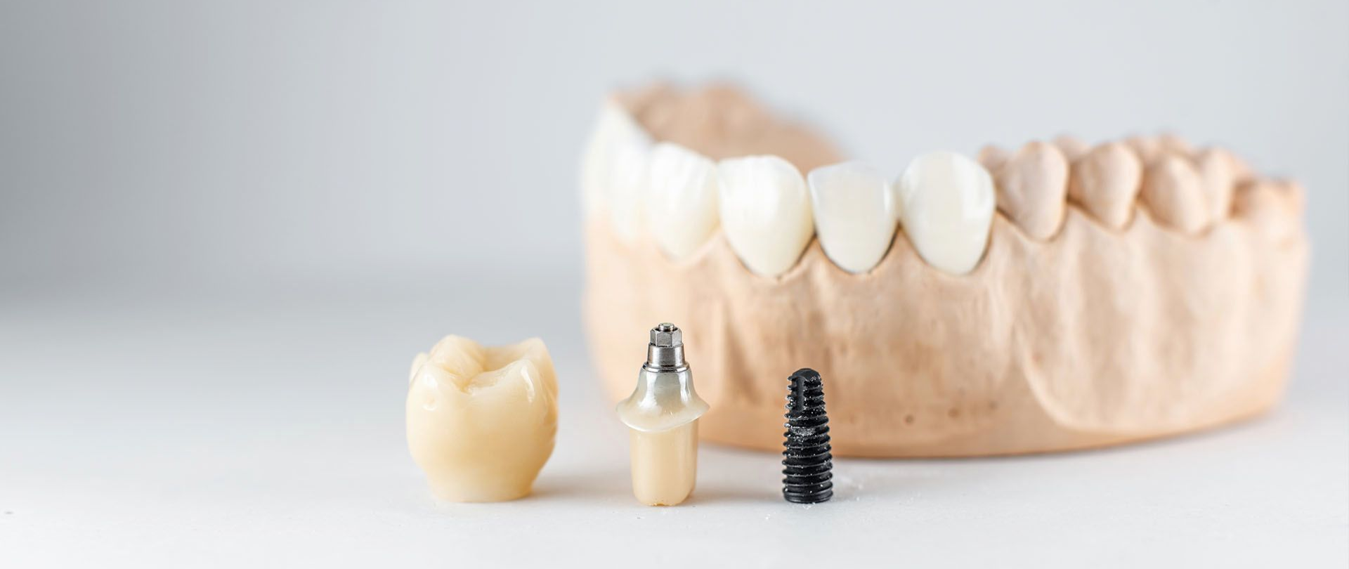 Dental implants and a tooth model on a white surface.