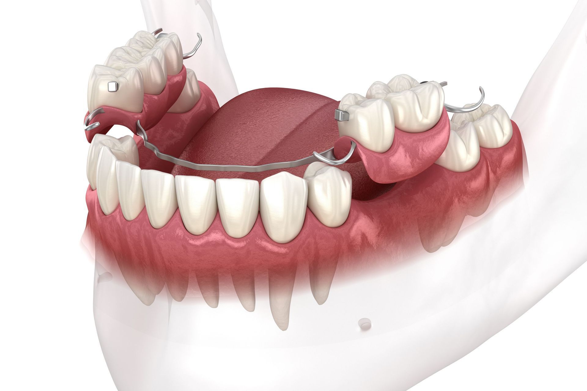 A computer generated image of a dental flipper in a person 's mouth.