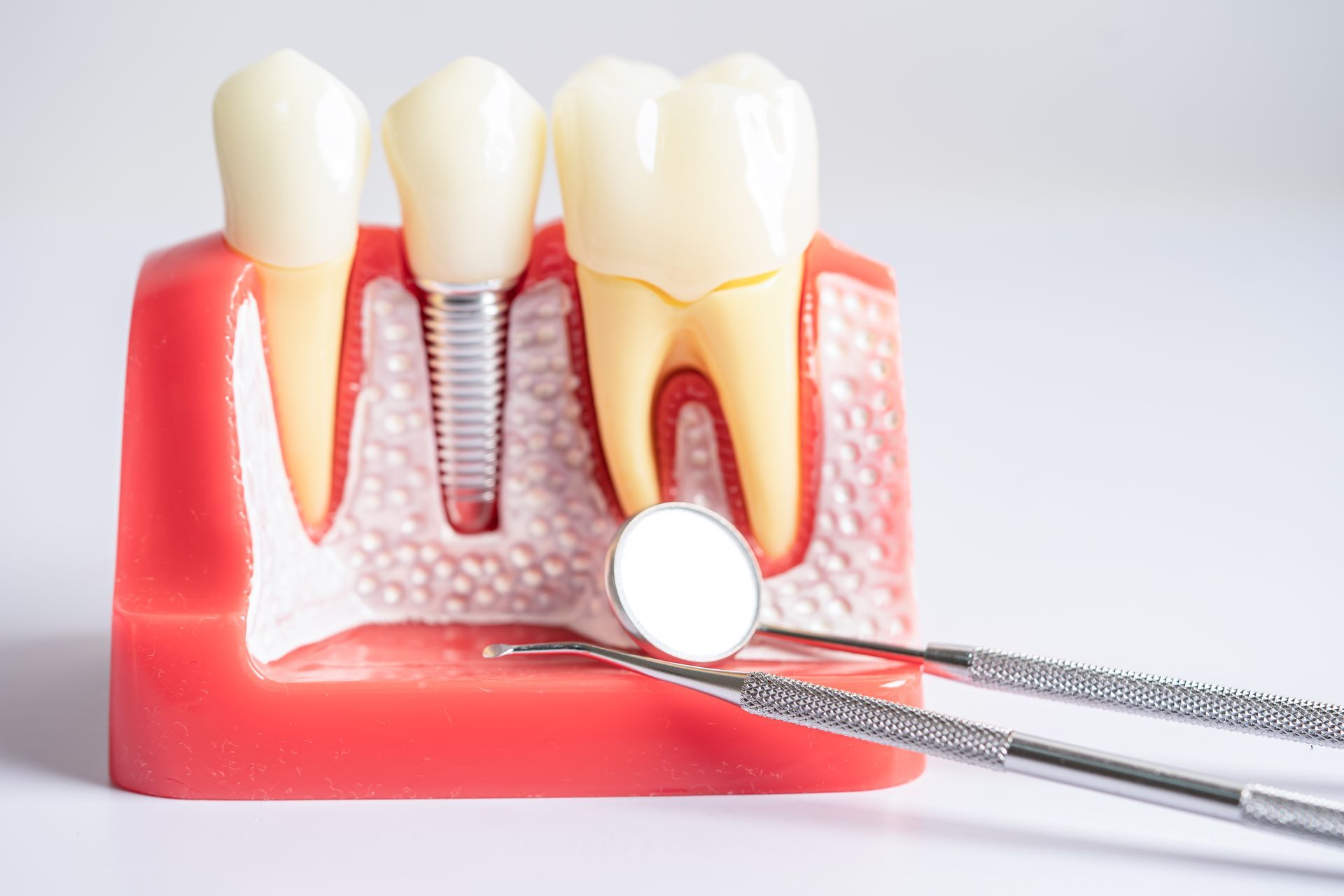 Detailed dental implant model showing artificial tooth roots embedded in the jaw, used for educational and patient consultation purposes.