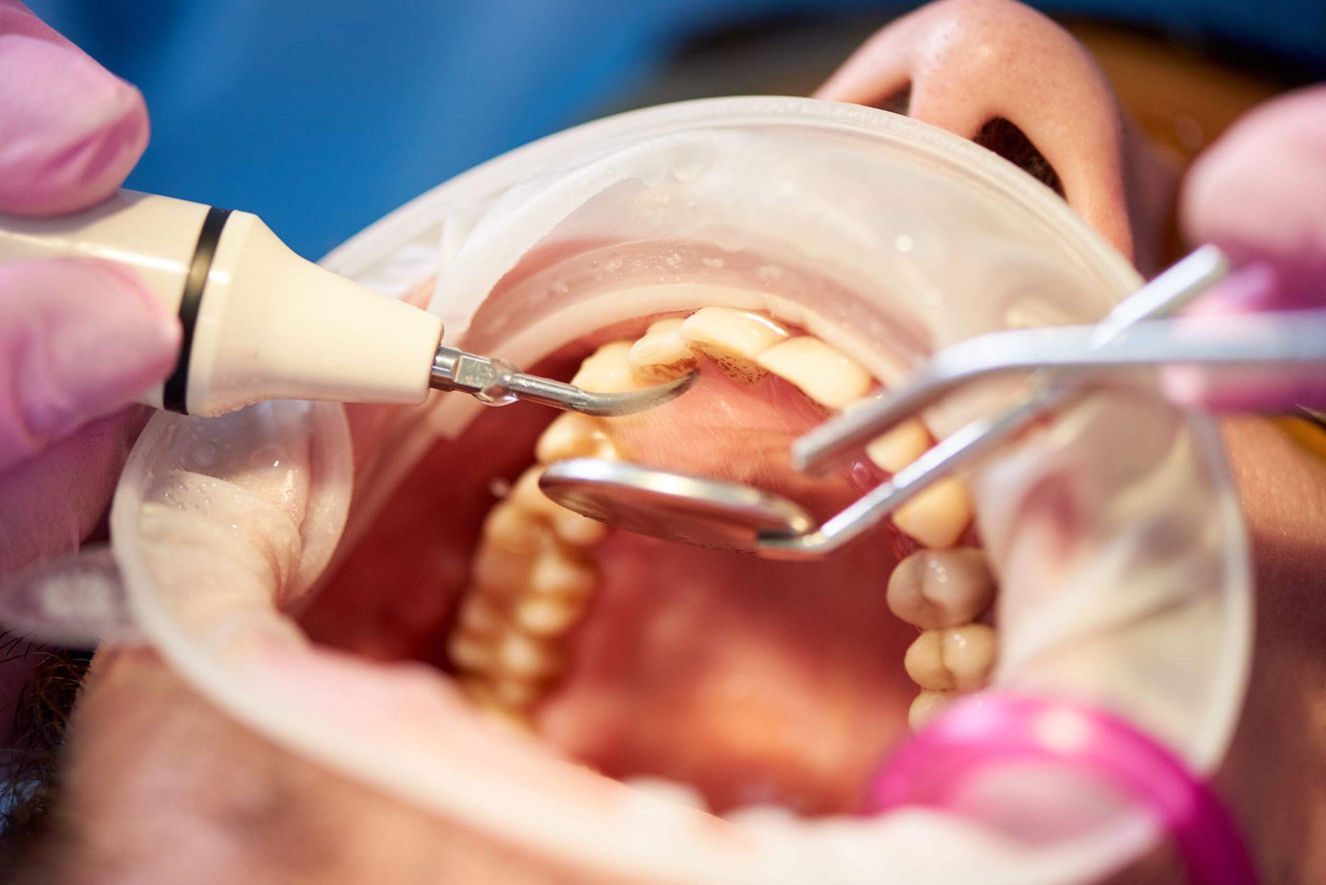 Macro photo of a dental examination focusing on a patient’s teeth using advanced tools, emphasizing professional dental care.