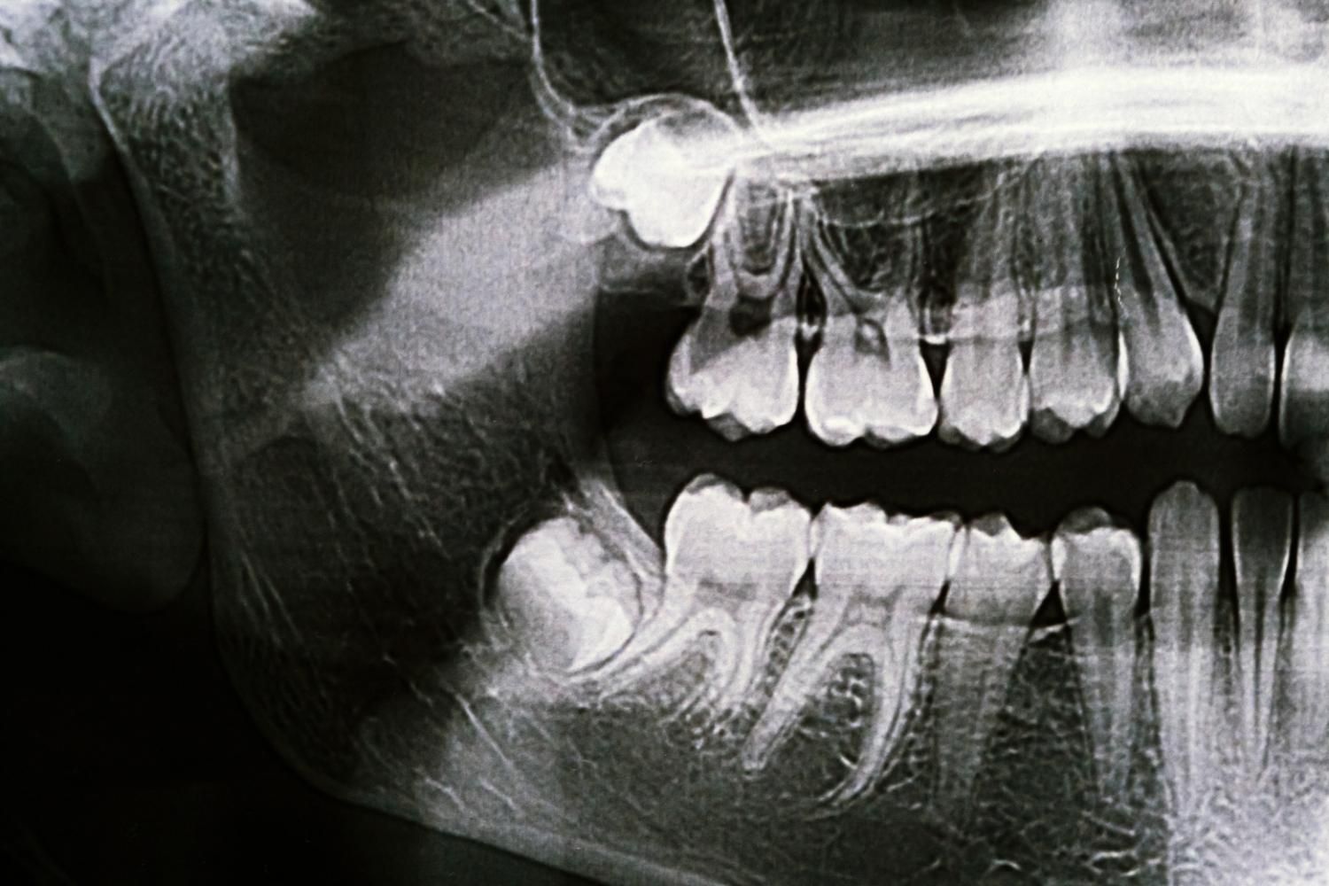 A black and white x-ray of a person 's teeth.