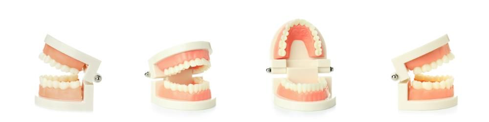 Traditional Full Mouth Implants
