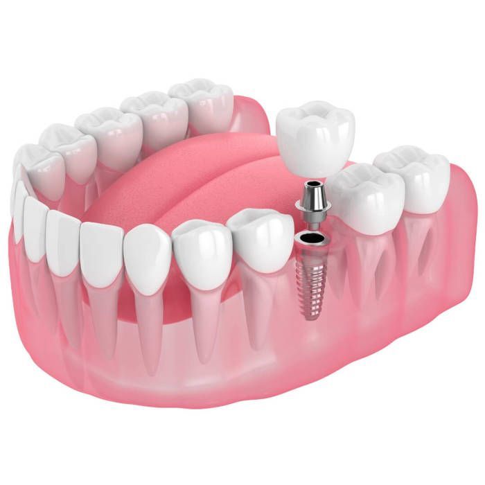 A model of a tooth with a single tooth implant