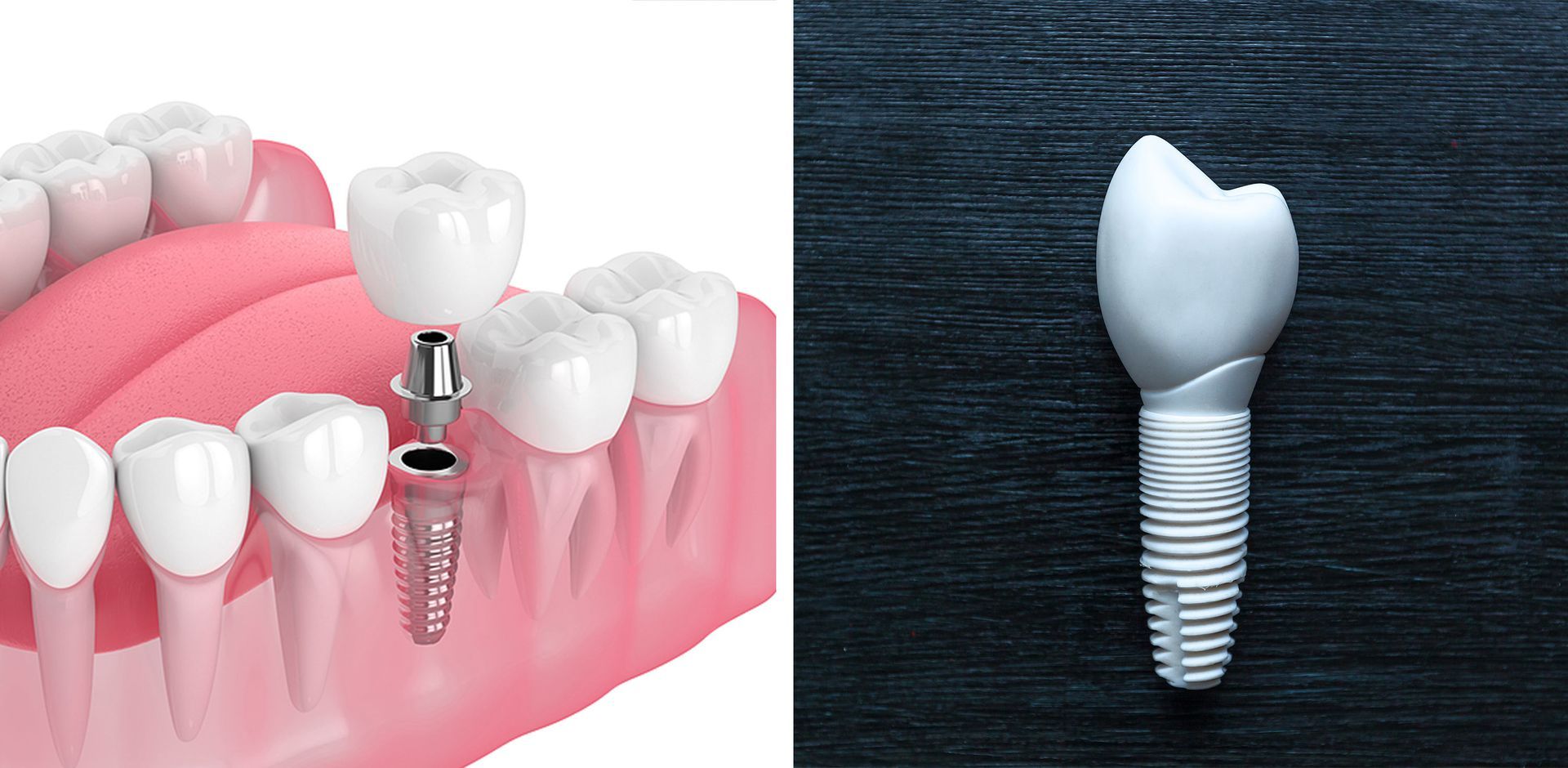 Zirconia Dental Implants vs. Titanium